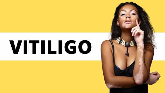 VITILIGO – CAUSAS EMOCIONAIS